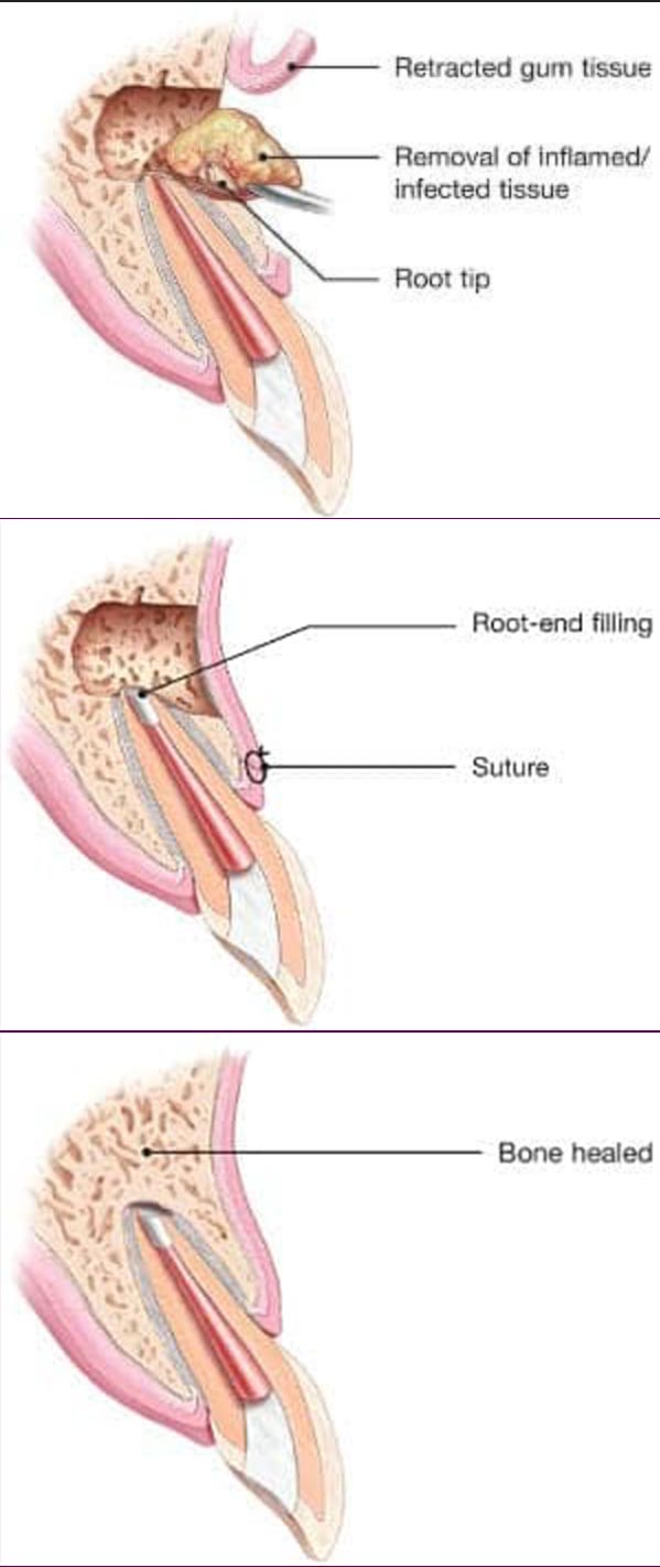 Endodontic Microsurgery in Clinton
