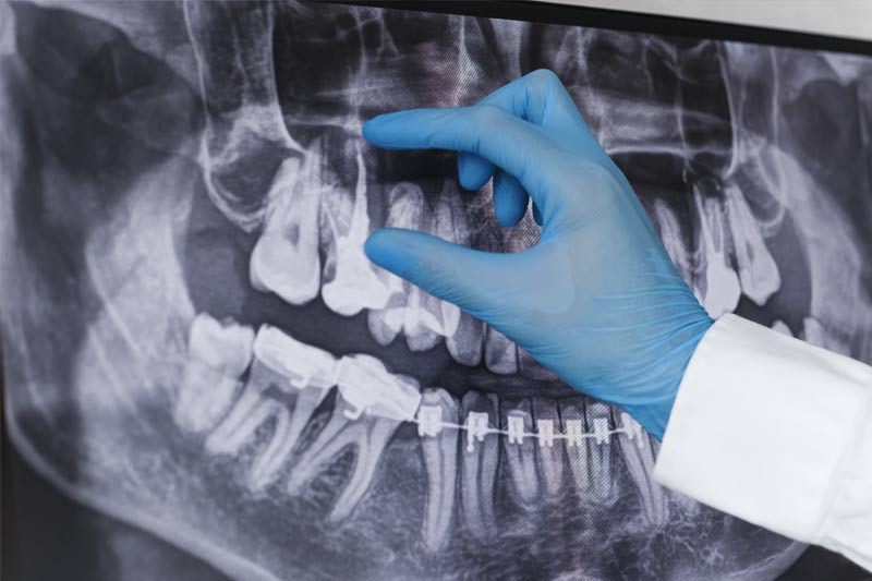 Root Canal Re-Treatment in Clinton